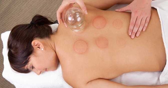 Cupping